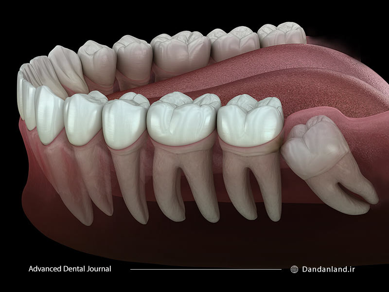 مشکلات دندان عقل نهفته